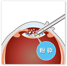 濁った水晶体を取り除く