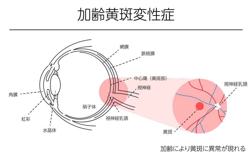 加齢黄斑変性とは
