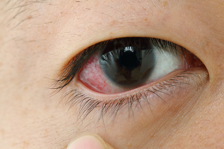 うつる目の病気？「結膜炎」とは