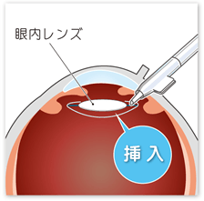 眼内レンズを挿入する