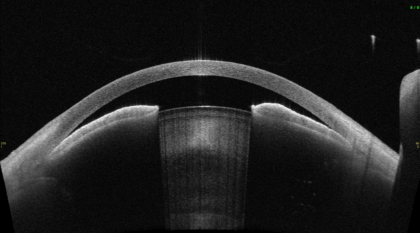 隅角が非常に狭く、眼圧が非常に上昇し緑内障発作となっている状態