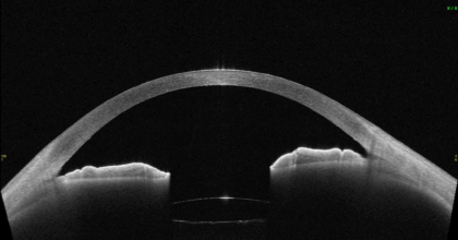 白内障手術を行い、隅角が広がった状態