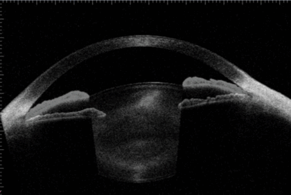 手術前後の画像を重ね合わせると、隅角が広がっていることがよくわかります