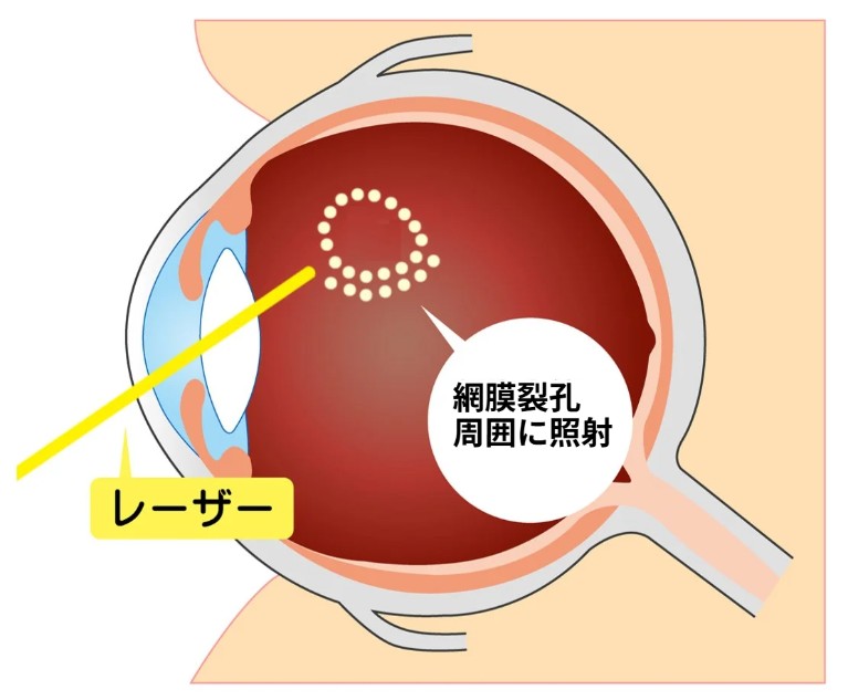 網膜剥離に対するレーザー治療